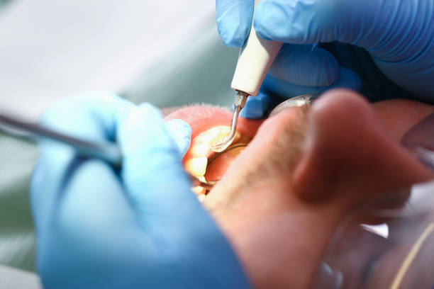 Best Emergency Root Canal Treatment in Plattsmouth, NE