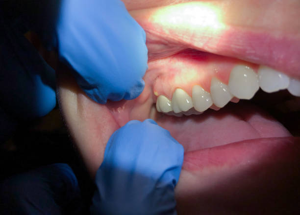 Best Emergency Tooth Extraction in Plattsmouth, NE